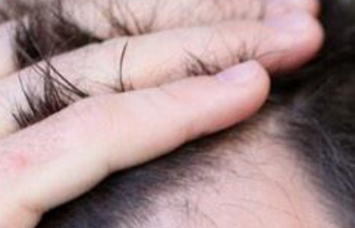 Saç kaybı ve mucize tedaviler!