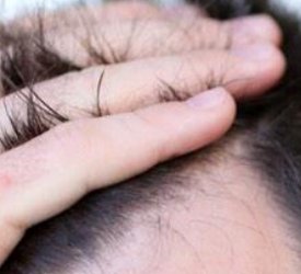 Saç kaybı ve mucize tedaviler!