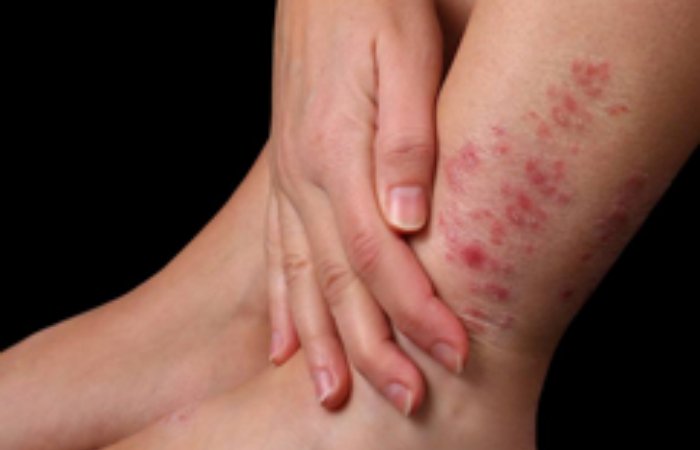 Sedef Hastalığı Ve Hipertansiyon Arasında İlişki Var