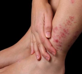 Sedef Hastalığı Ve Hipertansiyon Arasında İlişki Var