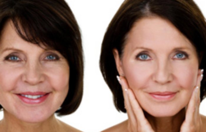 Botox Deride Antiaging Etki Yapıyor!