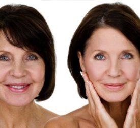 Botox Deride Antiaging Etki Yapıyor!