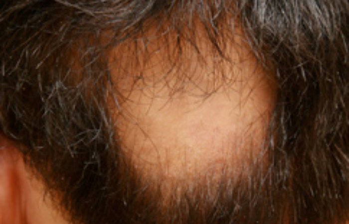 Yama Şeklinde Saç Dökülme Tedavisi Bulundu Mu?