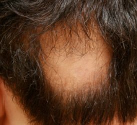 Yama Şeklinde Saç Dökülme Tedavisi Bulundu Mu?