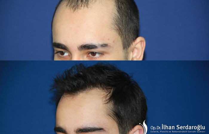 Ekilen Saç  Grefti  Kaç  Günde Tutar?