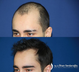 Ekilen Saç  Grefti  Kaç  Günde Tutar?