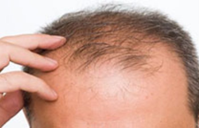 Erkeklerde En Önemli Saç Kaybı Nedenleri Nelerdir?