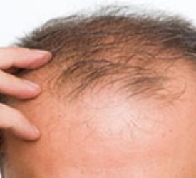 Erkeklerde En Önemli Saç Kaybı Nedenleri Nelerdir?