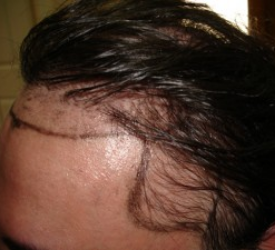 Herkese saç ekilebilir mi, kimlere saç ekimi yapılmaz?