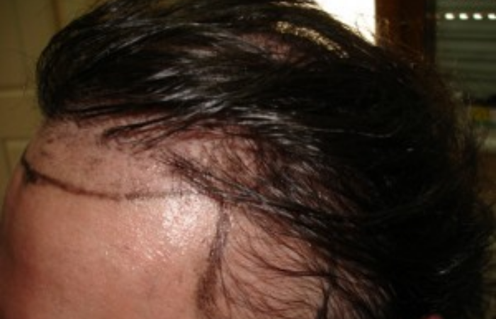 Herkese saç ekilebilir mi, kimlere saç ekimi yapılmaz?