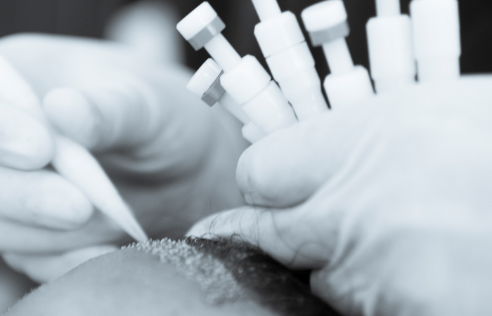 Kalemle saç  ekimi (Choi İmplanter) nedir?