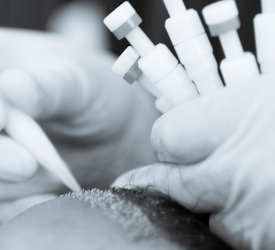 Kalemle saç  ekimi (Choi İmplanter) nedir?