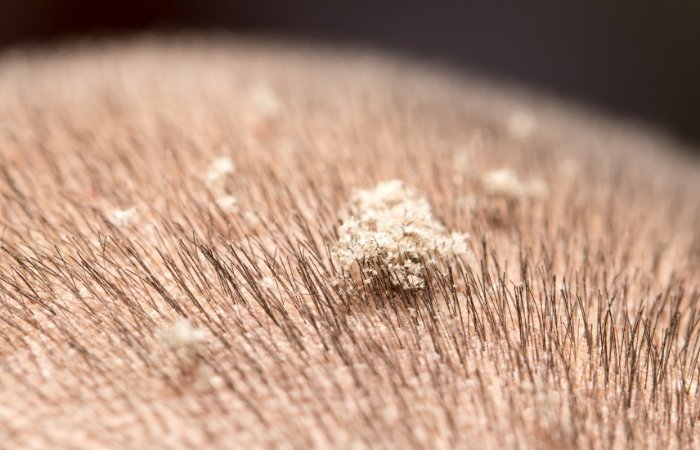 Kepek Saç Dökülmesine Sebep Olur mu?