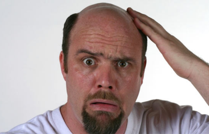 Koroner Kalp Hastalıkları Ve Kellik Arasında Bir İlişki Mi Var?