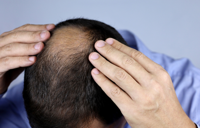 Liken Pilanopilaris Nedir, Saç Kaybinda Saç Ekimi Yapilabilir mi?