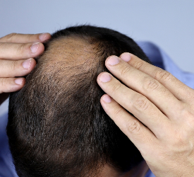 Liken Pilanopilaris Nedir, Saç Kaybinda Saç Ekimi Yapilabilir mi?