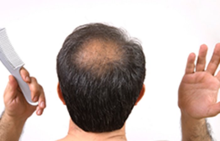 Saç Mezoterapisi Saç Dökülmesini Önler Mi?