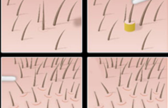 Saç Ekiminde Çığır Açan Teknik: Fue