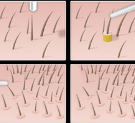 Saç Ekiminde Çığır Açan Teknik: Fue