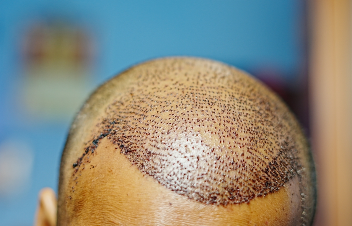 Saç ekiminde maksimum kaç saç kökü ekilebilir, saç ekimi ne kadar sürer?