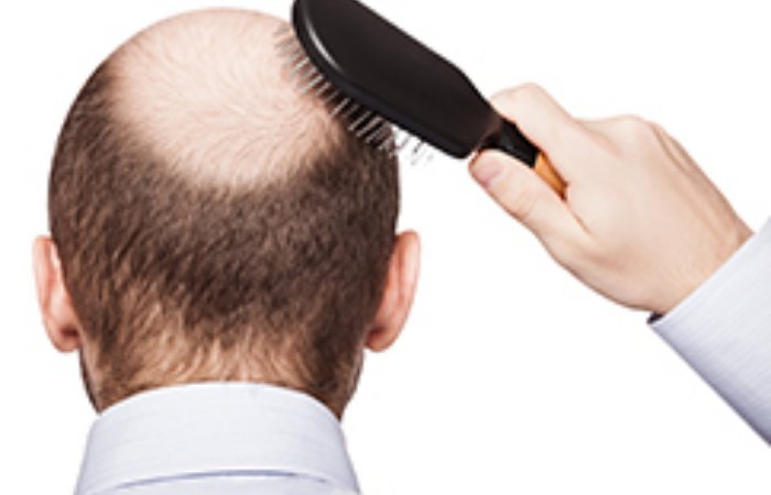 Saç Ekimi Öncesi Nelere Dikkat Etmeliyiz?