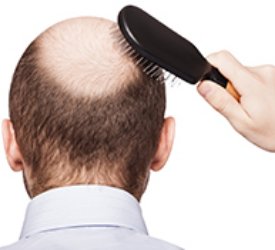 Saç Ekimi Öncesi Nelere Dikkat Etmeliyiz?