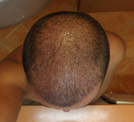 Saç Ekimi Sonrası 2. Hafta Sonunda Ekilen Alanda Hala Kabuk Varsa?