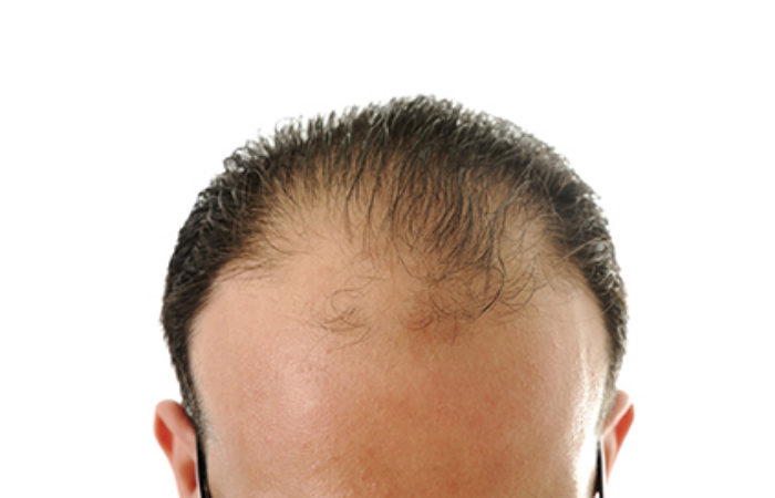 Saç ekimi sonrası günlük yaşama ne zaman başlanır, tatile ve spora ne zaman gidilmeli?