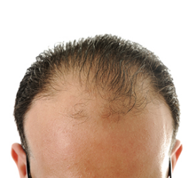 Saç ekimi sonrası günlük yaşama ne zaman başlanır, tatile ve spora ne zaman gidilmeli?