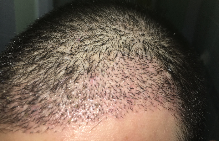 Saç ekimi sonrası saçlarda asimetrik dökülme neden olur?