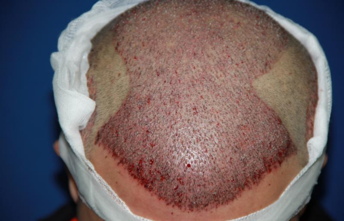 Saç ekimi sonrasında greftler kaç günde tutar? 