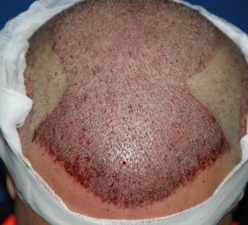 Saç ekimi sonrasında greftler kaç günde tutar? 