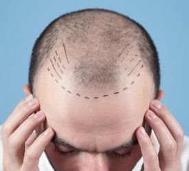 Saç ekimi tarihçesi nedir, ne zamandır saç ekimi yapılmakta?