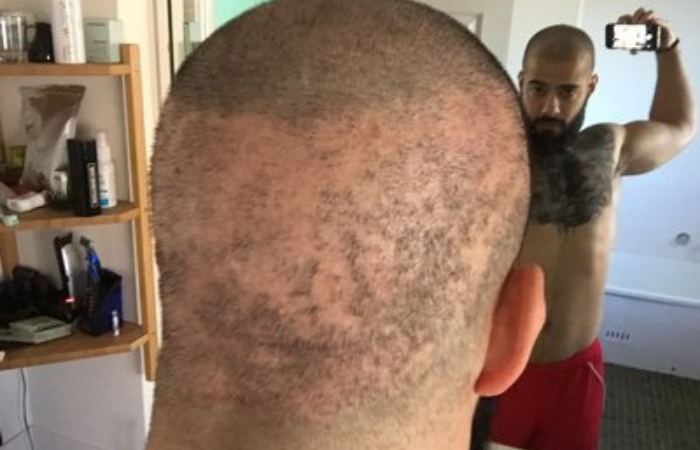 Saç Ekimi Yaptırırken Saçlarınızdan Olmayın! Operasyonunun Riskleri Ve Bilinmeyenleri