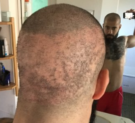 Saç Ekimi Yaptırırken Saçlarınızdan Olmayın! Operasyonunun Riskleri Ve Bilinmeyenleri