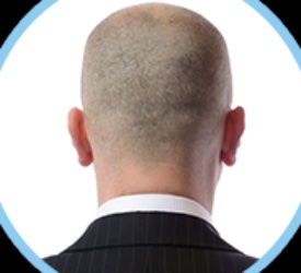 Saç Ekiminde FUT Yöntemi 