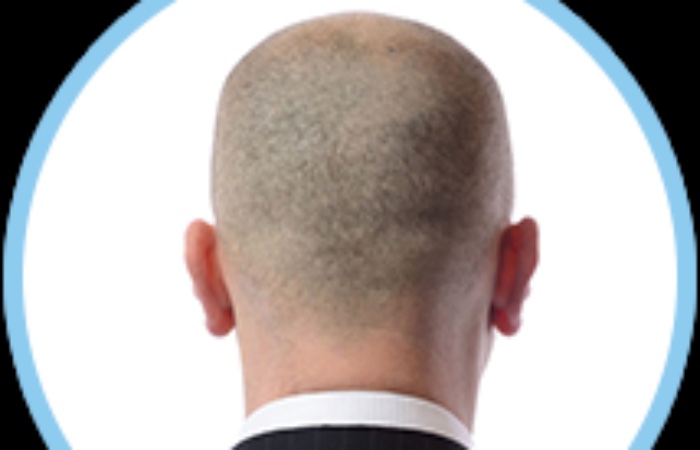 Saç Ekiminde FUT Yöntemi 