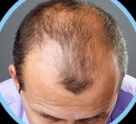 Saçlı Deride Operasyon İzlerinin Yok Edilmesi 