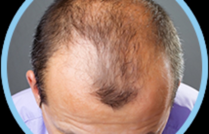 Saçlı Deride Operasyon İzlerinin Yok Edilmesi 