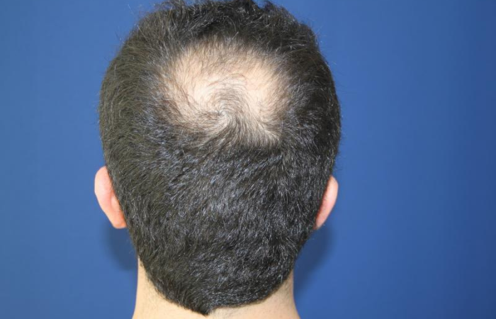 Saç Ekimleri Vertex (Tepe) Bölgesine Yapıldığında, Gerçekten Tutmaz mı?