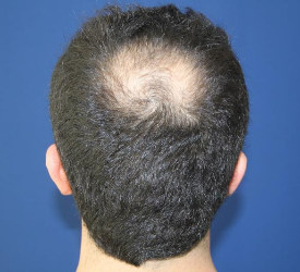 Saç Ekimleri Vertex (Tepe) Bölgesine Yapıldığında, Gerçekten Tutmaz mı?