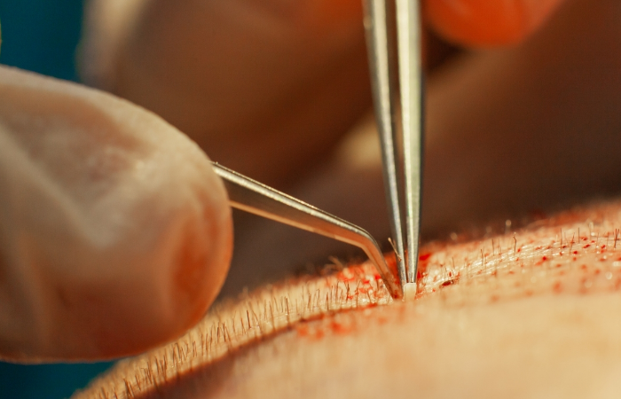 Greft nedir, saç kökü nedir?