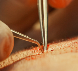 Greft nedir, saç kökü nedir?