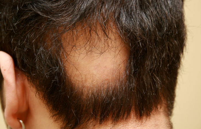 Saç Kıran Sonrası Dökülen Saçlarımız Geri Gelir mi?