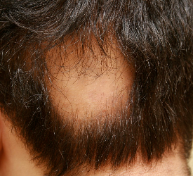 Saç Kıran Sonrası Dökülen Saçlarımız Geri Gelir mi?