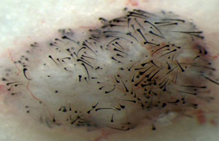 Saç Klonlamaya Yaklaştık mı? Saç Ekimi Tarihe mi Karışıyor?