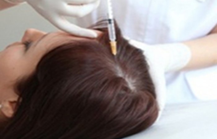 Saç Mezoterapisi