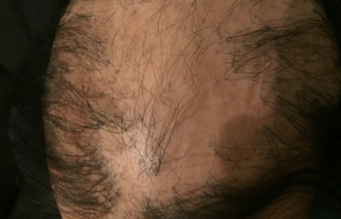 Skarlı Saç Kıran (Alopesi Areata) Nasıl Tedavi Edilir?