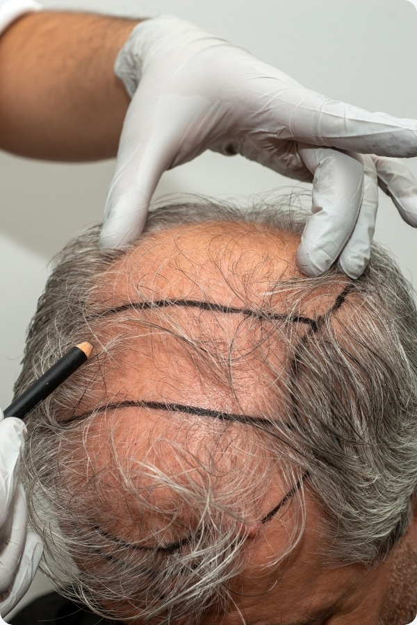 TRAŞSIZ FUE SAÇ EKİMİ