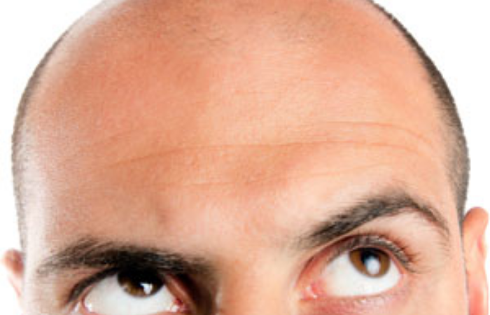 Saç klonlaması yapılabiliyor mu, saç aşısı tedavisi nedir, işe yarar mı?